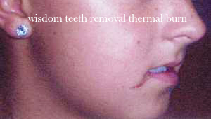wisdom teeth thermal burn