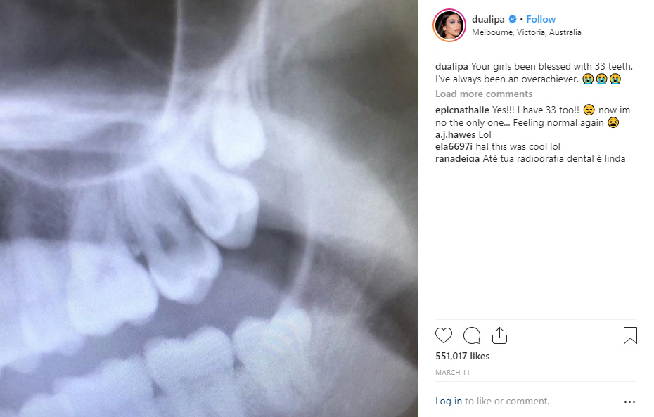 dua lupa wisdom teeth x ray 1 - Recent Celebrities to have Wisdom Teeth Removal