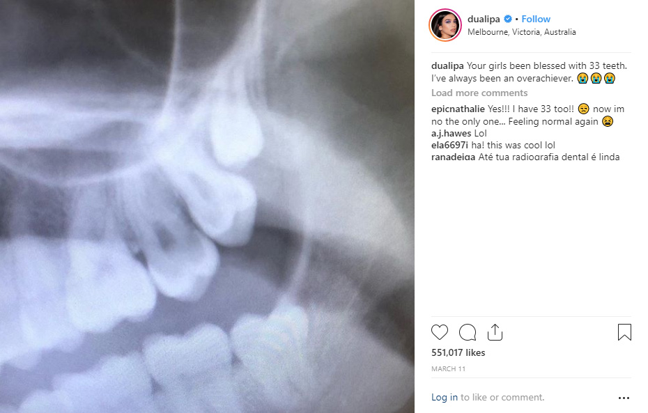 dua lipa wisdom teeth x-ray