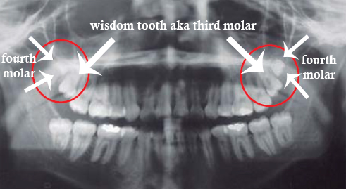 fourth molar xray teeth - Why Do Some People have a Fourth Molar?