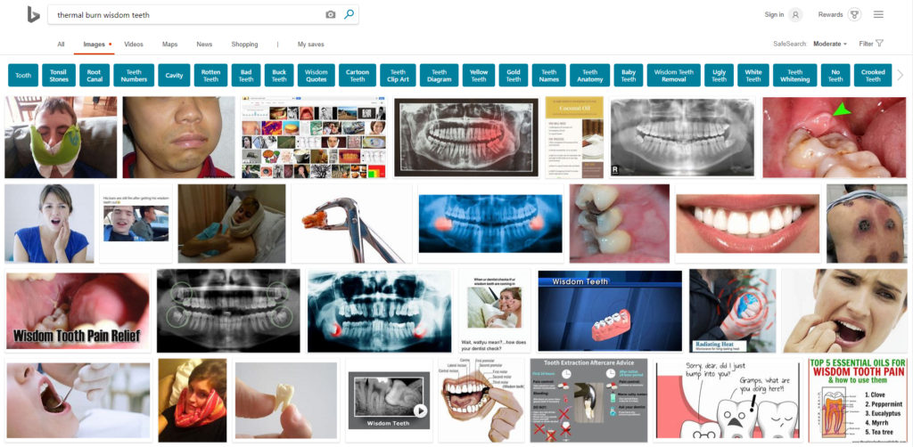 thermal burn wisdom teeth Bing 2019 1024x502 - Dental Drills Leading to Thermal Burns