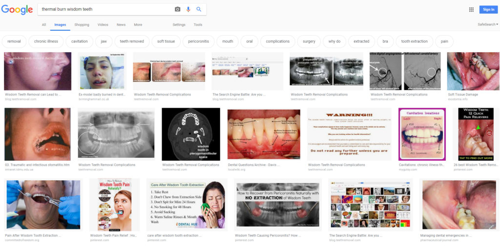 thermal burn wisdom teeth Google 2019 1024x507 - Dental Drills Leading to Thermal Burns