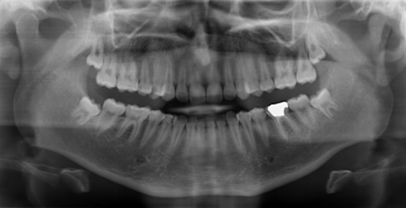 wisdom teeth orthopantomogram xray - Using lower wisdom teeth developmental stages determined from panoramic x-rays to calculate age
