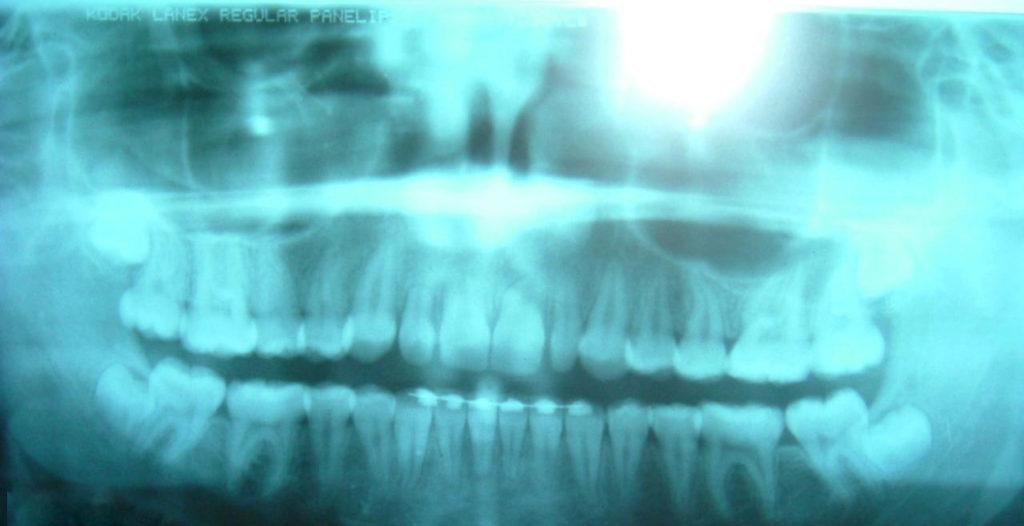 wisdom teeth panoramic x ray 1024x526 - Using Panoramic X-Rays of Lower Wisdom Teeth to Legally Prove if Someone is Older than 18 Years and 21 Years