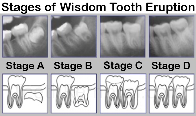 wisdom tooth eruption staging olze - Forensic Age Estimation using Wisdom Teeth