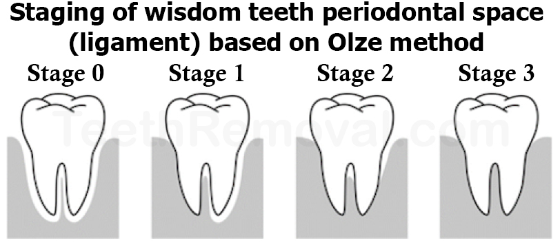 wisdom tooth staging periodontal space olze 1 - Using Panoramic X-Rays of Lower Wisdom Teeth to Legally Prove if Someone is Older than 18 Years and 21 Years