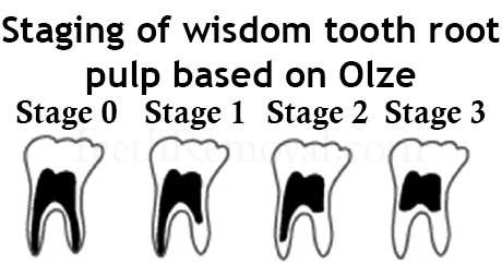 wisdom tooth staging root pulp olze - Using Panoramic X-Rays of Lower Wisdom Teeth to Legally Prove if Someone is Older than 18 Years and 21 Years