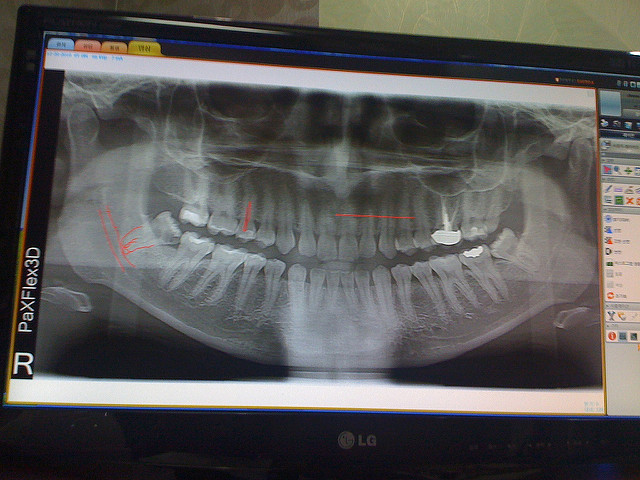 x ray of wisdom teeth - Proving a Person is Older than 18 Years Based on the Periodontal Space (Ligament) and Root Pulp of Lower Wisdom Teeth from Imaging