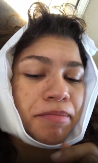 zendaya wisdom teeth removal - Recent Celebrities to have Wisdom Teeth Removal