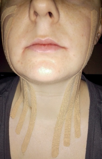 kinesiology taping wisdom teeth removal - Kinesiology Taping Following Wisdom Teeth Removal