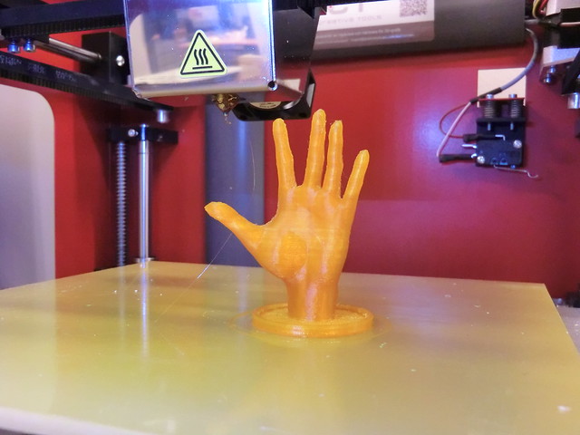 3D printed hand - 3D Printing for Impacted Wisdom Teeth