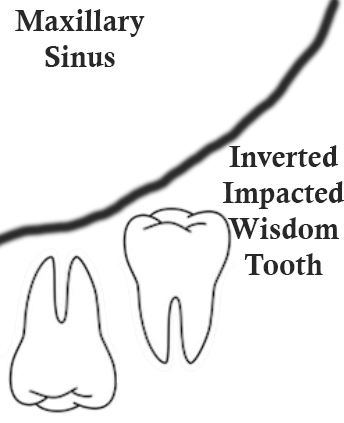 inverted impacted wisdom tooth - What to do with an Inverted (Upside Down) Impacted Wisdom Tooth?