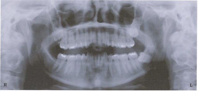 panoramic xray wisdom teeth - The Predictive Value of using Panoramic X-Rays for Wisdom Teeth Surgery Complications