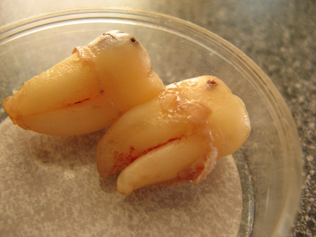 two extracted wisdom teeth - An Index to Assess Surgical Difficulty of Impacted Wisdom Teeth