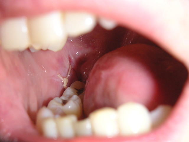 wisdom teeth removal stitches socket - What is the Likelihood of Dry Socket After Wisdom Teeth Removal?