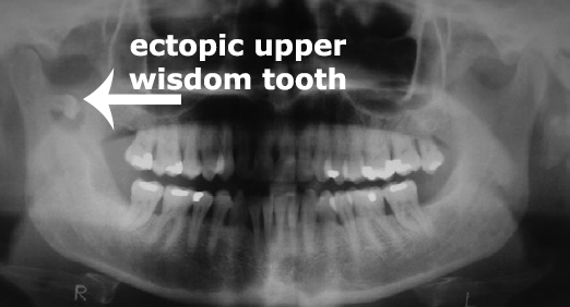 ectopic wisdom tooth - Management for an Ectopic Wisdom Tooth