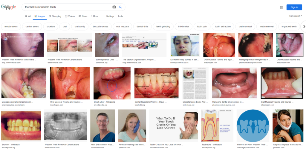 google wisdom teeth thermal burn 2020 1024x507 - Dental Drills Leading to Thermal Burns