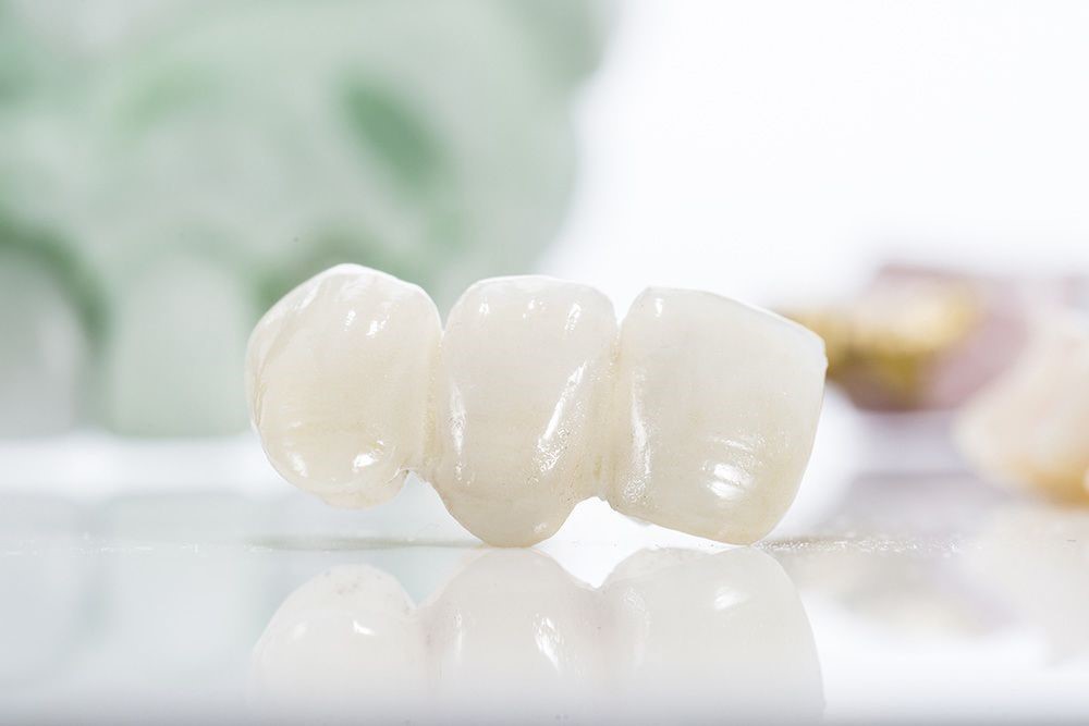 dental bridge teeth - Dental Bridges in Jacksonville - Benefits of Getting Them