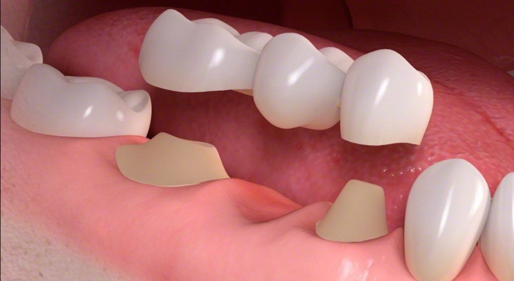 mouth tooth missing 1024x561 - Dental Bridges in Jacksonville - Benefits of Getting Them
