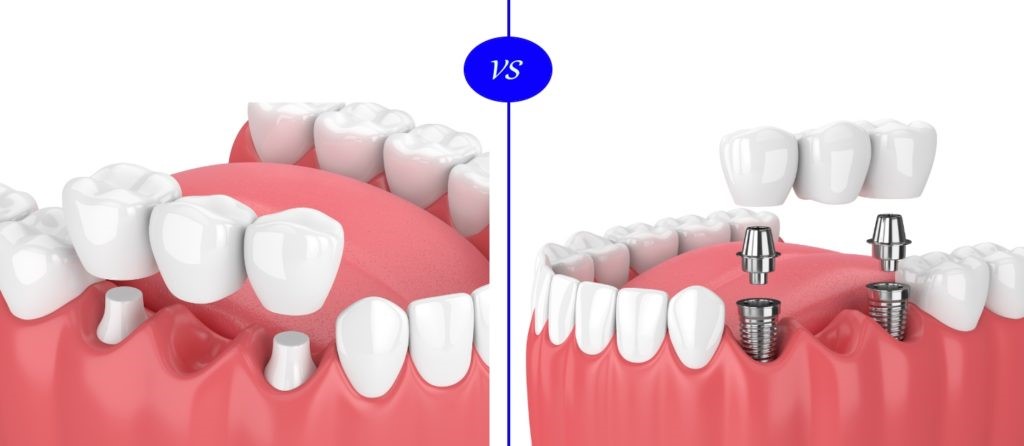 dental implants comparison