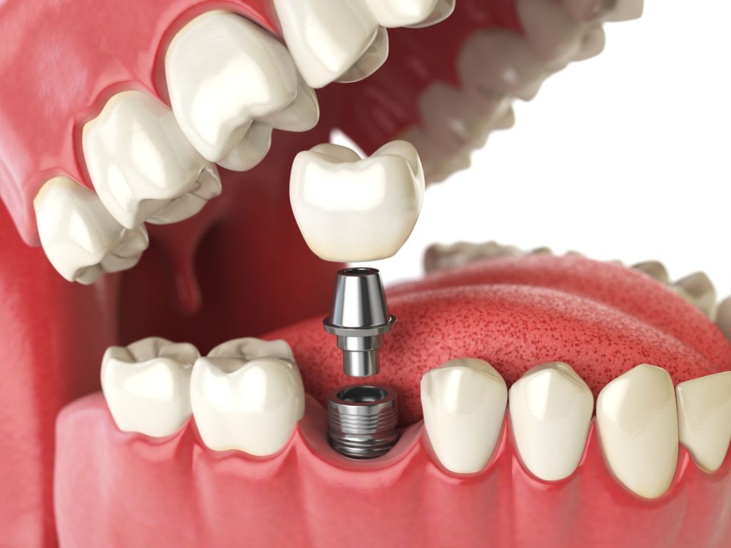 dental implants insertion 1024x768 - How to Get Low Cost Dental Implants Done