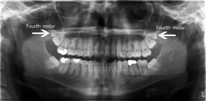 mandibular peg fourth molar 300x148 - mandibular_peg_fourth_molar