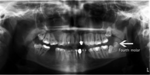 maxillary fourth molar 300x150 - maxillary_fourth_molar