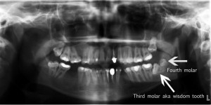 maxillary fourth molar wisdom teeth 300x150 - maxillary_fourth_molar_wisdom_teeth