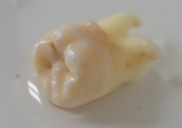 extracted wisdom tooth - Recommendations on Accidental Displacement of a Wisdom Tooth
