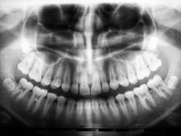 wisdom teeth xray - Comparing Wisdom Teeth in the United States of America and Sweden