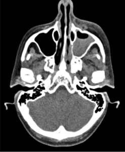 axial CT sinus opacification 247x300 - axial_CT_sinus_opacification