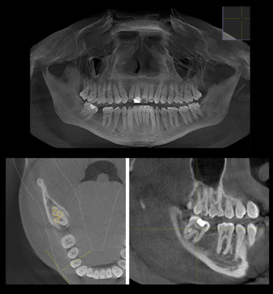 cbct fused wisdom tooth 952x1024 - Using Imaging to Help Treat a Fused Wisdom Tooth