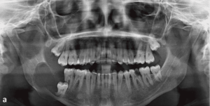 case one cyst wisdom teeth panoramic xray 300x151 - case_one_cyst_wisdom_teeth_panoramic_xray
