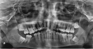 case two cyst wisdom teeth panoramic xray 300x160 - case_two_cyst_wisdom_teeth_panoramic_xray