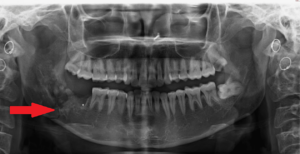 mandibular angle fracture wisdom tooth 300x154 - mandibular_angle_fracture_wisdom_tooth