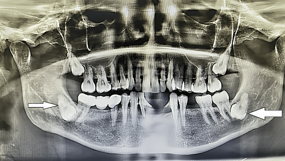 Bilateral Inverted and Impacted Wisdom Teeth case 1 one inverted wisdom tooth - Bilateral Inverted and Impacted Wisdom Teeth