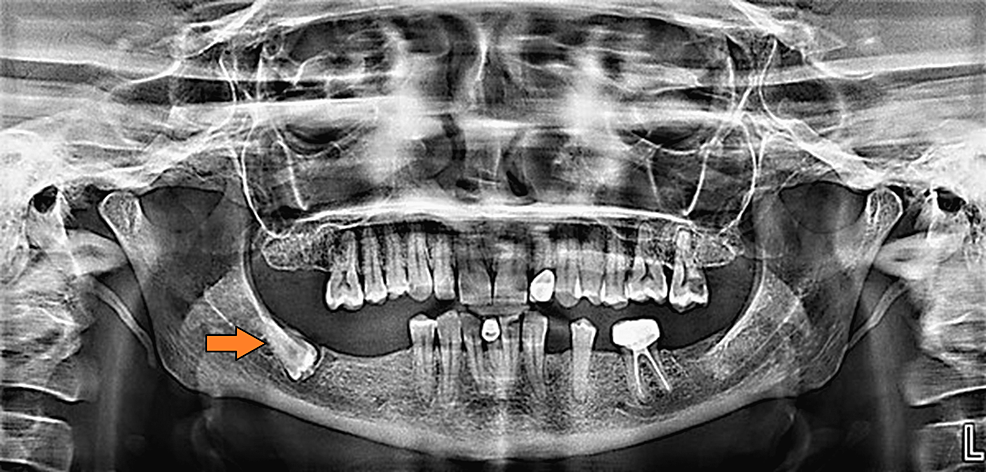 Bilateral Inverted and Impacted Wisdom Teeth case two one inverted wisdom tooth - Bilateral Inverted and Impacted Wisdom Teeth