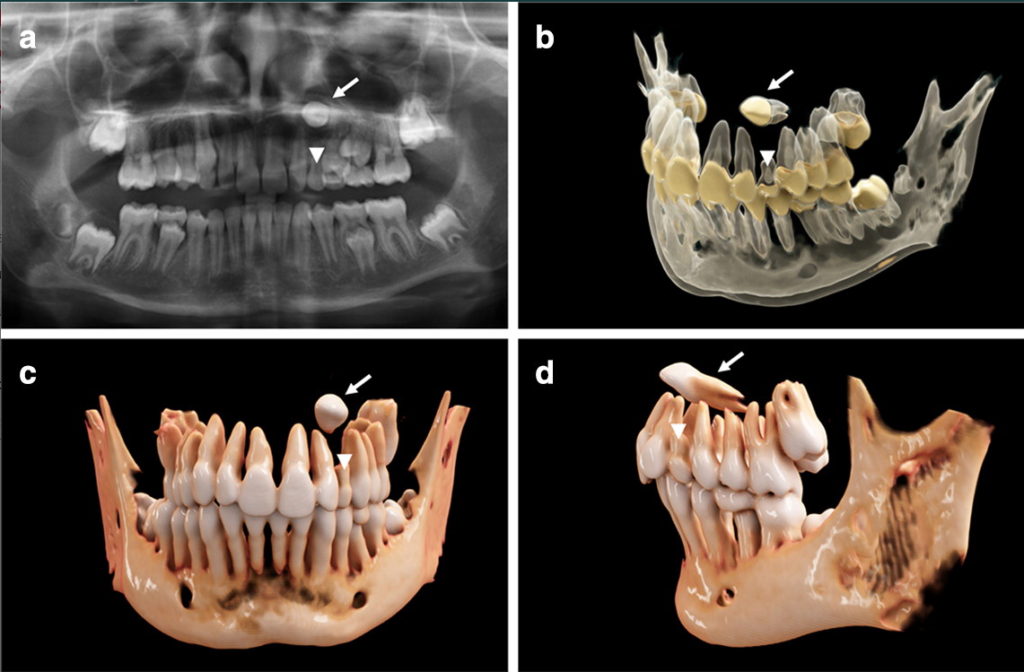 cinematic rendering teeth seven year old 1024x672 - Cinematic rendering to visualize teeth segmentation