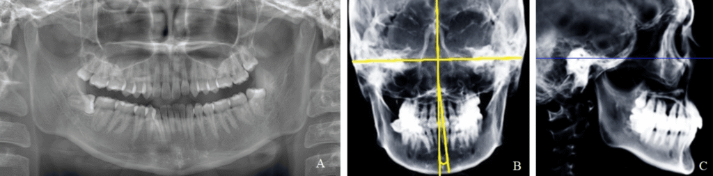 different angle group xray ct wisdom teeth 1024x253 - Could Wisdom Teeth Reveal More About Jaw Asymmetry Than We Thought?